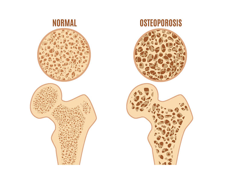 Abbildung Asteoporose
